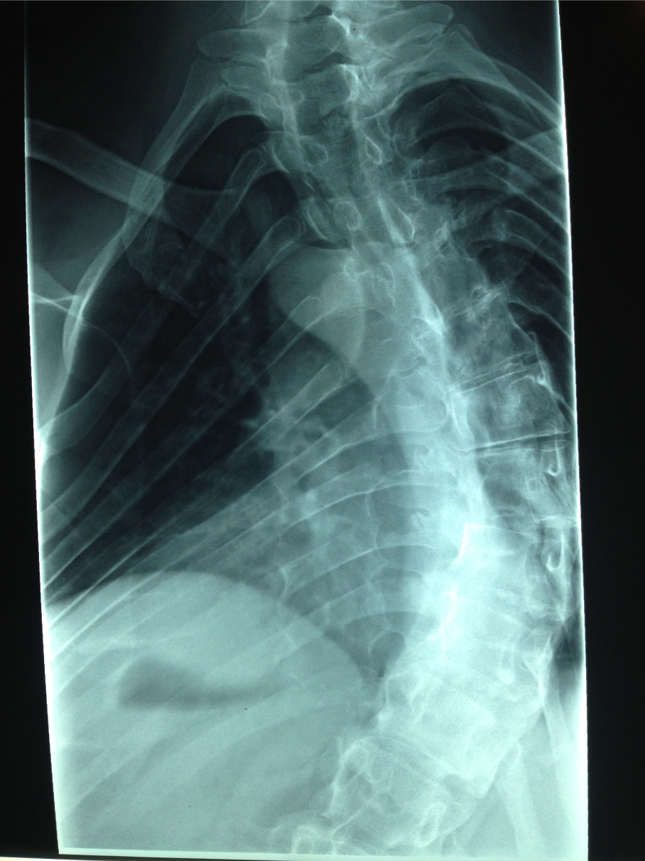 scoliosisphoto1